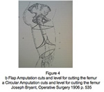 a Circular Amputation cuts ans level for cutting the femur; b Flap Amputation cuts and level for cutting the femur