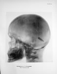 Radiograph of head with bullet