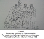 Un chirurgien et ses assistants pratiquant une amputation au niveau de la cuisse
