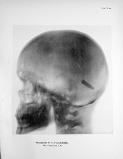 [ Radiograph of head with bullet ]
